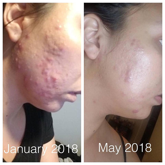 Organic Acne Treatment Serum