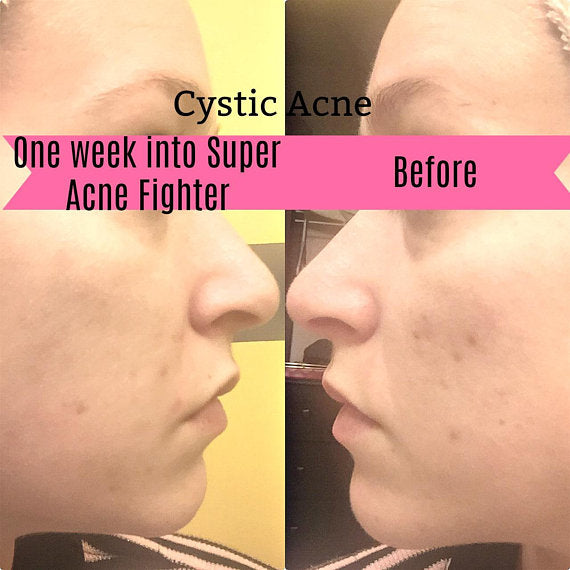 Organic Acne Treatment Serum